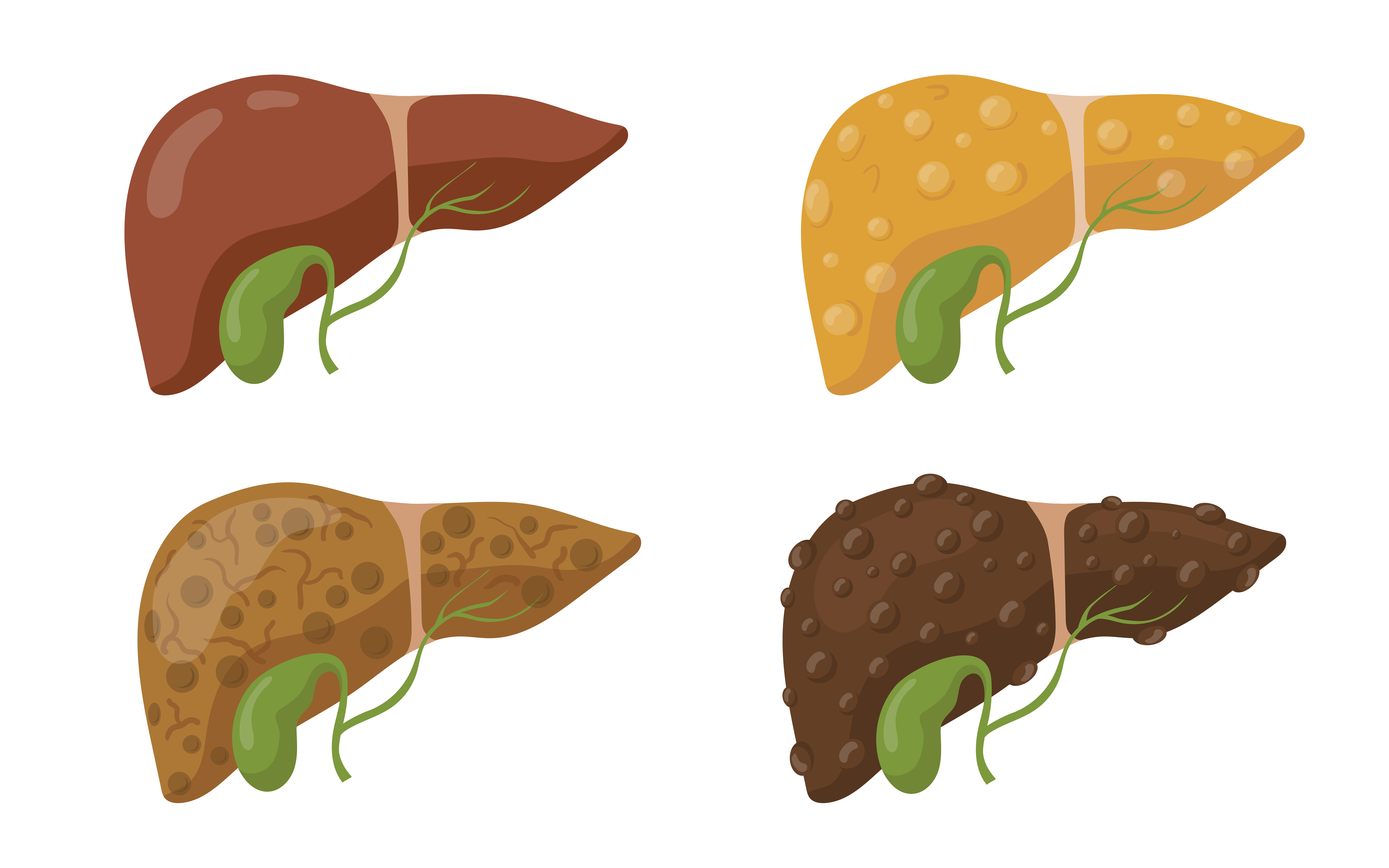 Stages of Liver Disease.jpg